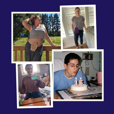 4 people living with IBD who have experienced living with an ostomy