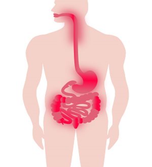 Digestive system showing inflammation in someone with Crohn's disease